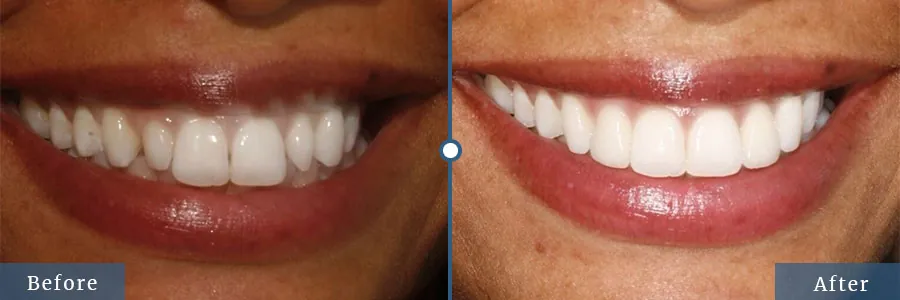 Veneers before and after — patient case 3 at Dallas Laser Dentistry