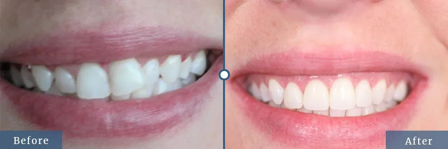 Veneers before and after — patient case 1 at Dallas Laser Dentistry