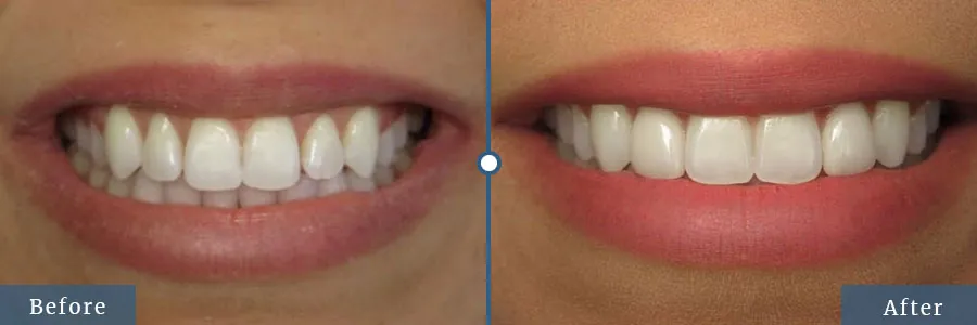Veneers before and after — patient case 2 at Dallas Laser Dentistry
