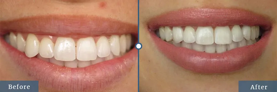Veneers before and after — patient case 4 at Dallas Laser Dentistry